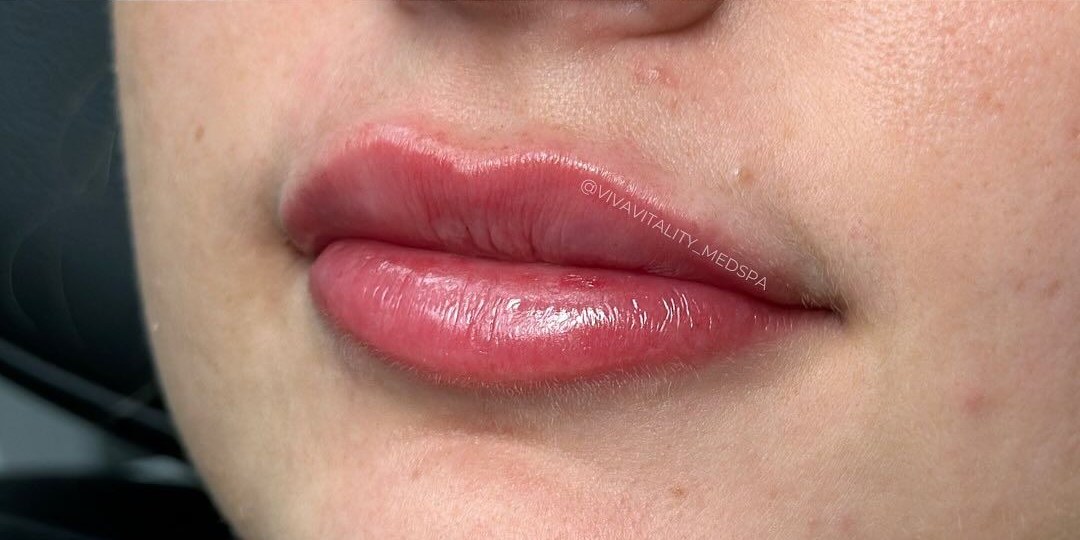 After Botox treatment