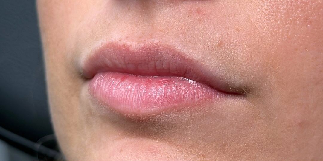 Before Botox treatment