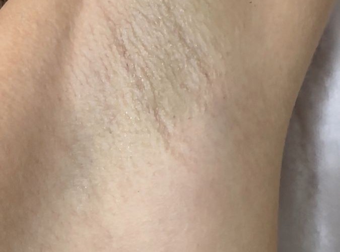 After laser hair removal
