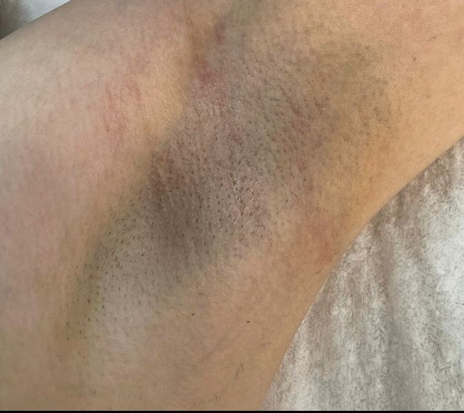 Before laser hair removal