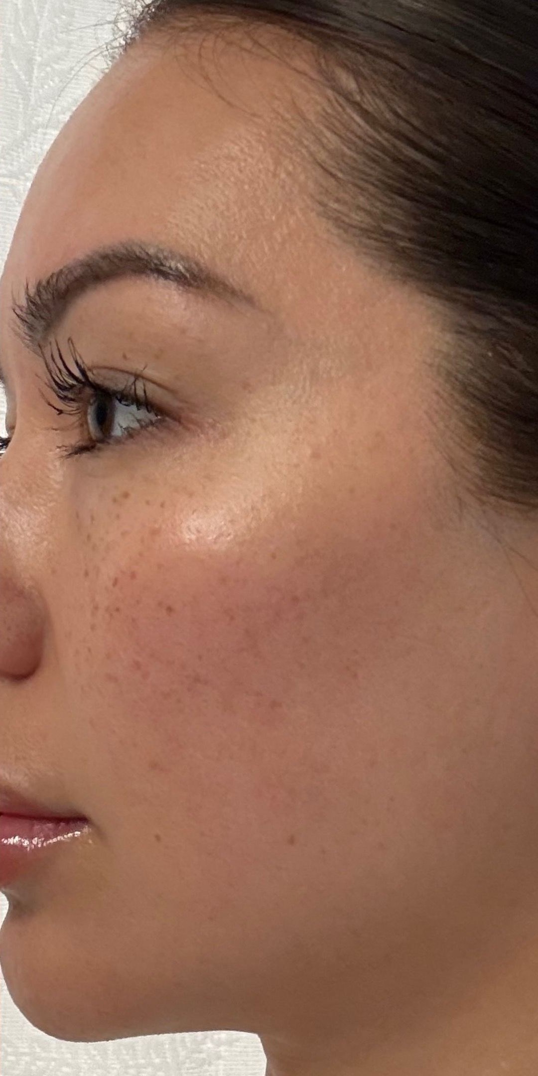 After skin rejuvenation