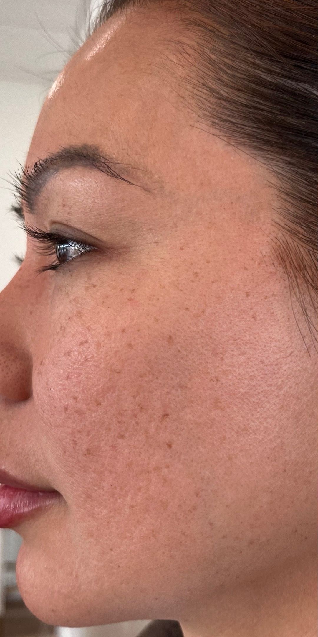 Before skin rejuvenation